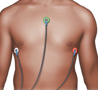Alternative electrode placement